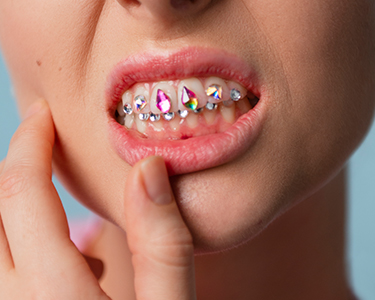 Tooth Gem Attachment in Turkey