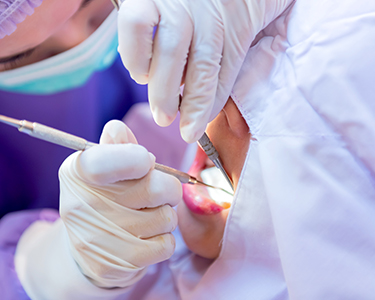 Scaling – Tartar Removal in Turkey