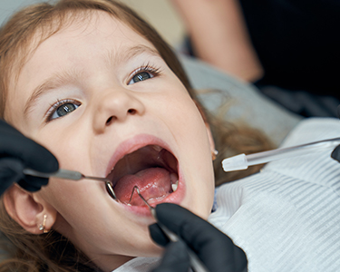 Fissure Sealant Applications in Turkey