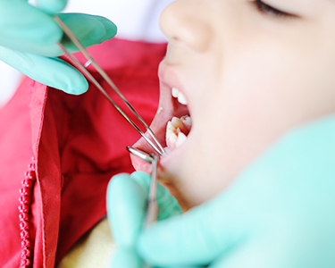 Gum Grafting in Turkey