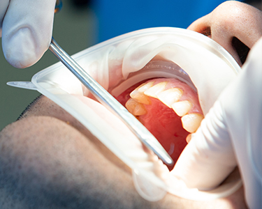 Impacted Tooth Extraction in Turkey