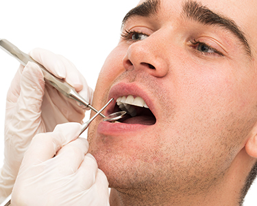 Impacted Tooth Extraction in Turkey