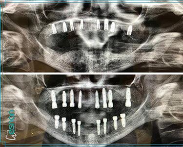 Radiology – Intraoral Diagnosis in Turkey