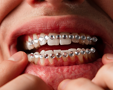 Tooth Gem Attachment in Turkey