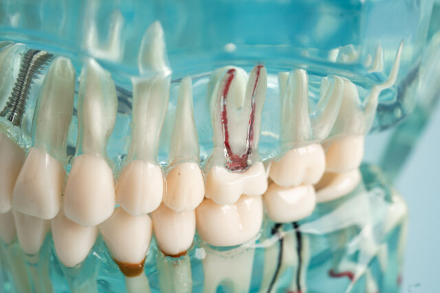 Endodontics Root Canal Treatment in Turkey