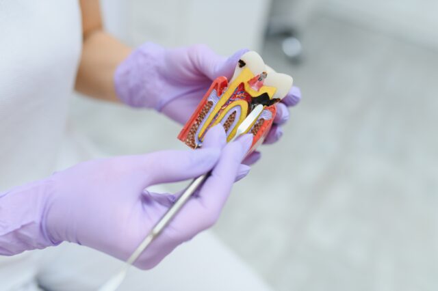Endodontics Root Canal Treatment in Turkey