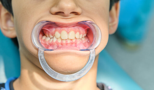 Orthodontics Crooked Teeth Treatment in Turkey