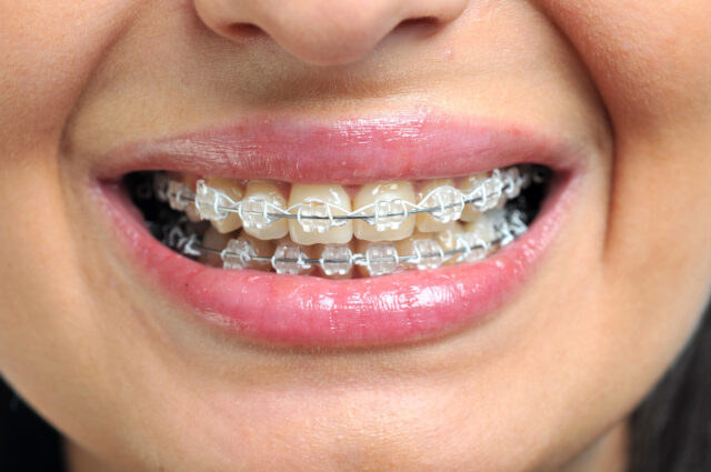 Orthodontics Crooked Teeth Treatment in Turkey