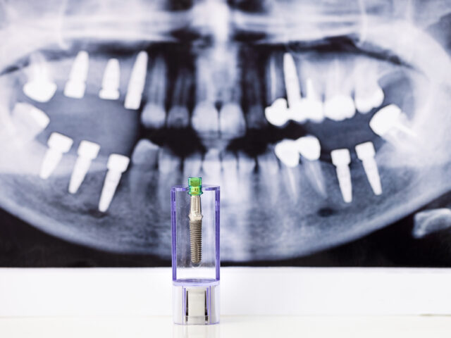 Best All-on-Six Implants in Istanbul : Your Guide to a New Smile