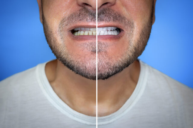 Turkey teeth before and after smile makeover at Esnan Dental Clinics Istanbul