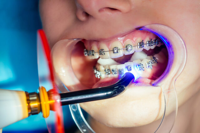 Comparison of braces and aligners for orthodontic treatment in Istanbul.