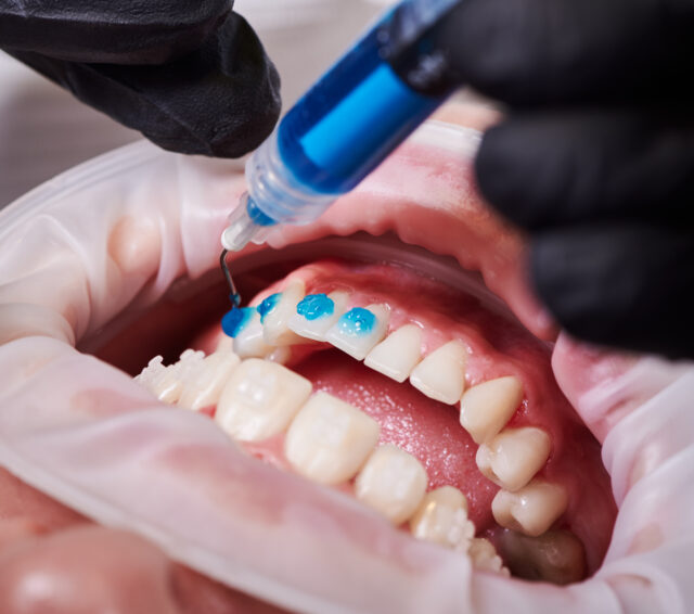Modern dental technology used for safe teeth whitening in Istanbul clinic