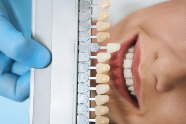Patient receiving affordable teeth whitening procedure in Istanbul dental clinic