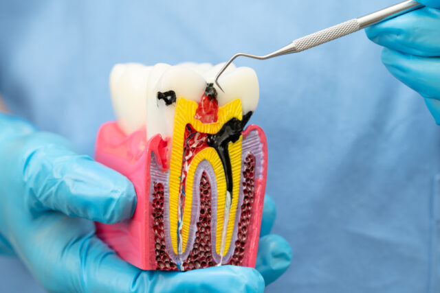 Root Canal Treatment in Istanbul