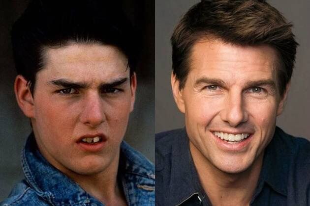 Tom Cruise Teeth
