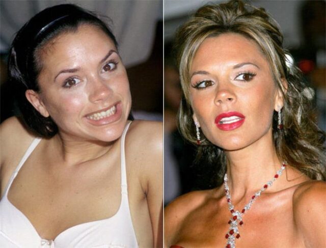 Victoria Beckham teeth