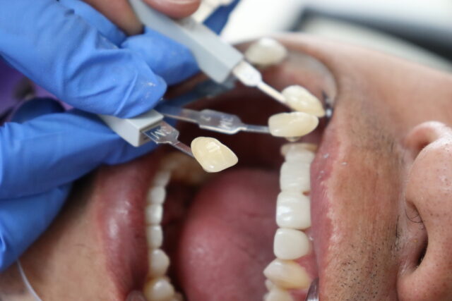 post veneer dental care