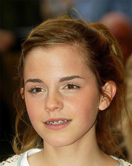emma watson teeth