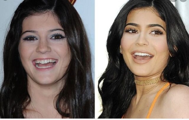 Kylie Jenner teeth