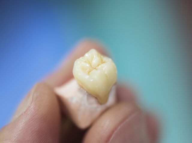 dental implant molar tooth