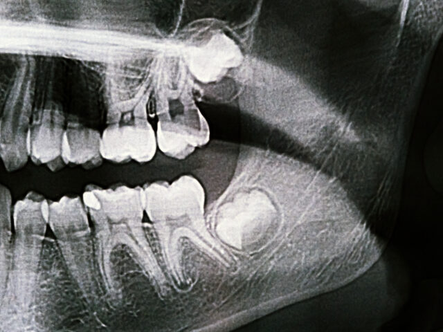 Pericoronitis: Wisdom Tooth Infection Explained