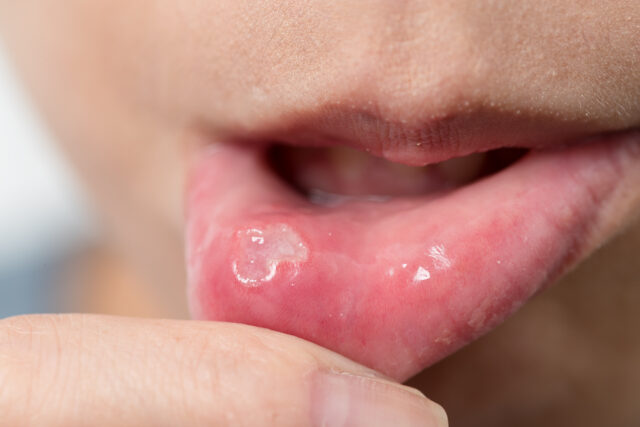 Oral Infection Symptoms